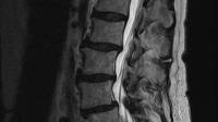 Non Surgical Spinal Decompression